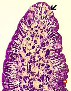  lipid malabsorption - large lipid droplets in enterocytes and propria … HE